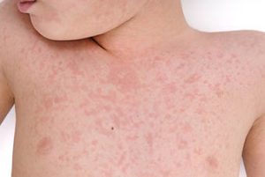 Measles: 14 Exposure Sites in Laval, Including Carrefour Laval